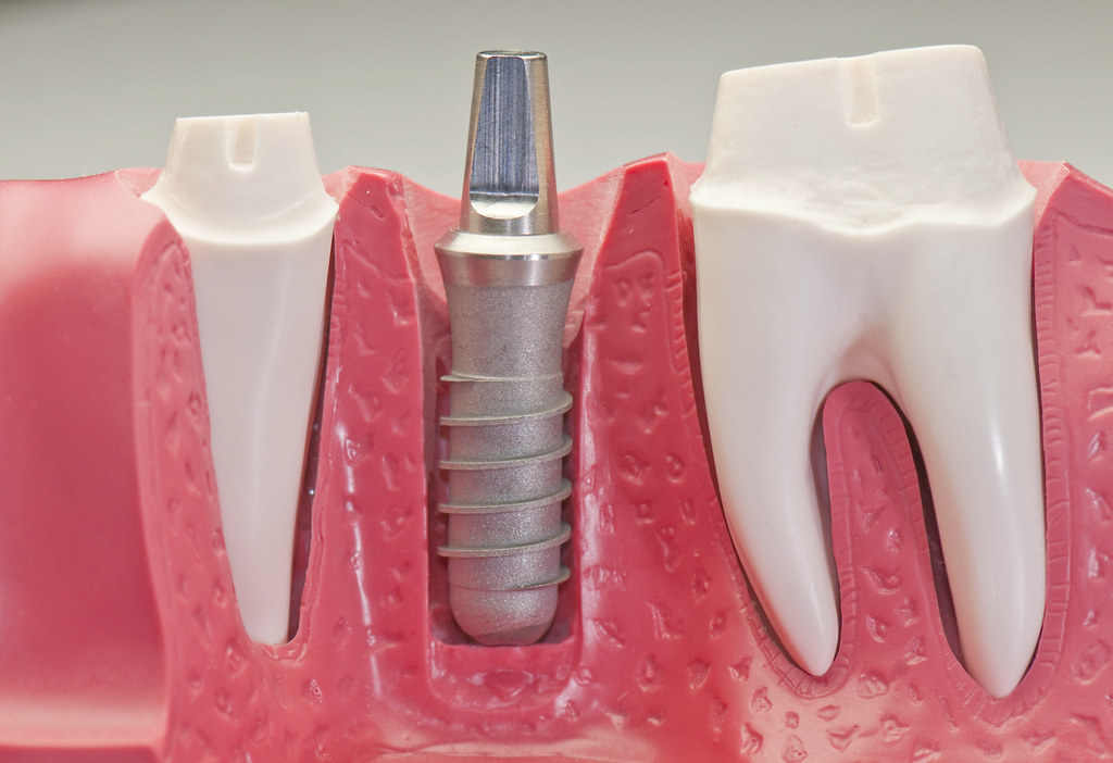 Modelo didático de implante dentário no osso